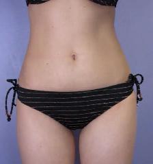 Permanent Fat Loss for stubborn fat. - Photo 4
