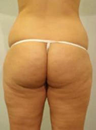 Permanent Fat Loss for stubborn fat. - Photo 5