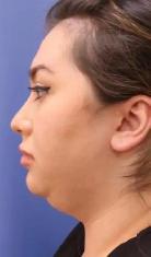 Permanent Fat Loss for stubborn fat. - Photo 9