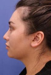 Permanent Fat Loss for stubborn fat. - Photo 10