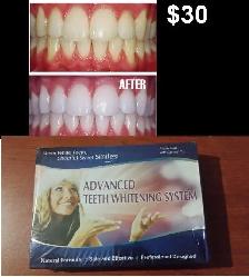 Advanced LED Teeth Whitening Kit – Whitening Gel   Blue Light