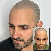 SCALP MICROPIGMENTATION & SCAR CAMOUFLAGE | MILTON - Photo 2