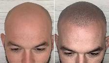 SCALP MICROPIGMENTATION & SCAR CAMOUFLAGE | MILTON - Photo 3
