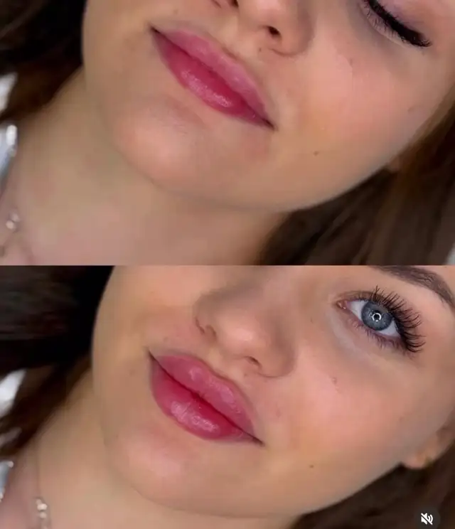 Fuller Lip filler