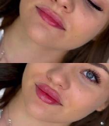 Fuller Lip filler