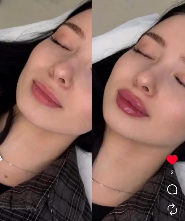 Natural Lips Filler