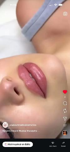 Natural Lips Filler - Photo 2