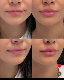 Natural Lips Filler - Photo 3