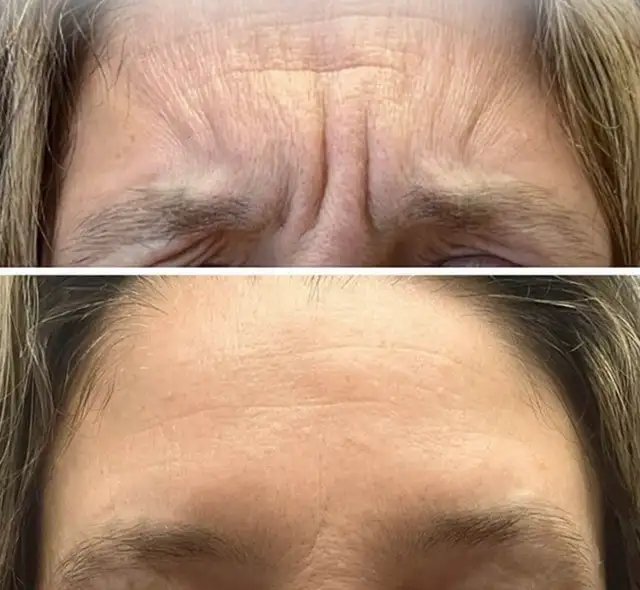 wrinkle removal - dermatologist