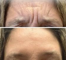 wrinkle removal - dermatologist