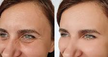 wrinkle removal - dermatologist - Photo 2