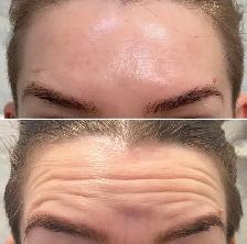 wrinkle removal - dermatologist - Photo 3