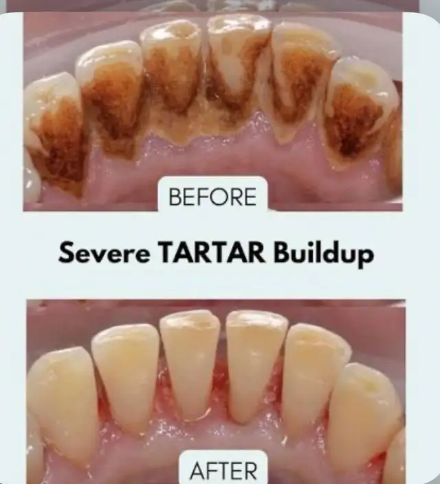 FREE CLEANING, X-RAYS & DENTIST CHECK