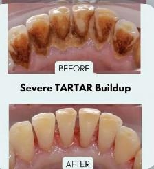 FREE CLEANING, X-RAYS & DENTIST CHECK