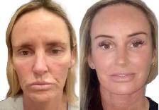 Nonsurgical Facelift / Liquid Facelift - Photo 3