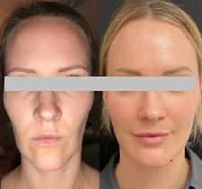 Nonsurgical Facelift / Liquid Facelift - Photo 6
