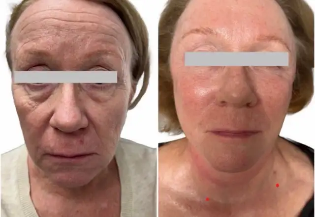 Skin Tightening treatment for face/ facelift