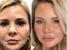 Skin Tightening treatment for face/ facelift - Photo 4