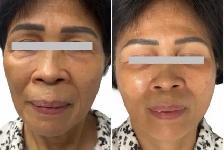 Skin Tightening treatment for face/ facelift - Photo 6