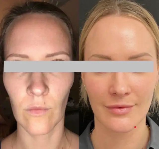 Botox for Face