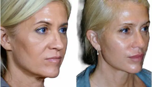 Botox Facelift