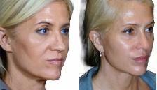 Botox Facelift