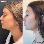 Kybella Lipo Injections (deoxycholic acid) - Photo 2