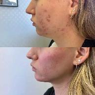 Kybella Lipo Injections (deoxycholic acid) - Photo 3