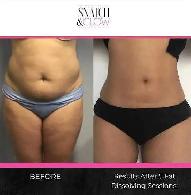 Kybella Lipo Injections (deoxycholic acid) - Photo 4