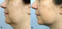 Kybella Lipo Injections (deoxycholic acid) - Photo 5