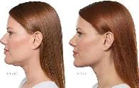 Kybella Lipo Injections (deoxycholic acid) - Photo 6