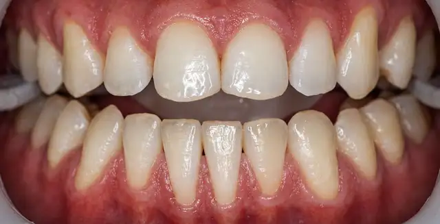 Teeth Cleaning $100