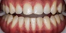 Teeth Cleaning $100