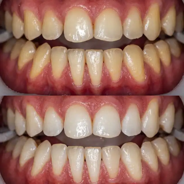 teeth whitening