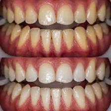 teeth whitening