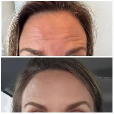 Chrysalis Beauté Botox Treatment - Photo 2
